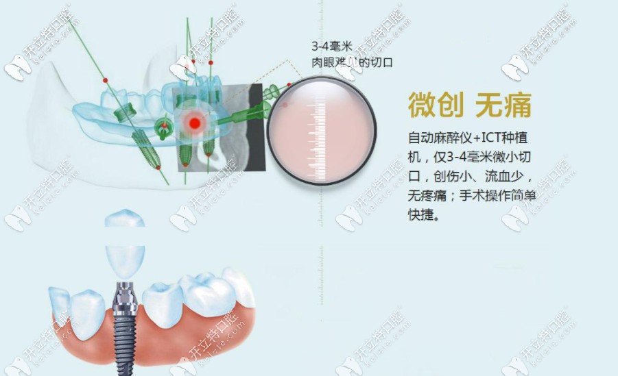 微創(chuàng)種植 微創(chuàng)種植