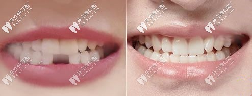 漯河舒適美口腔的種植牙案例