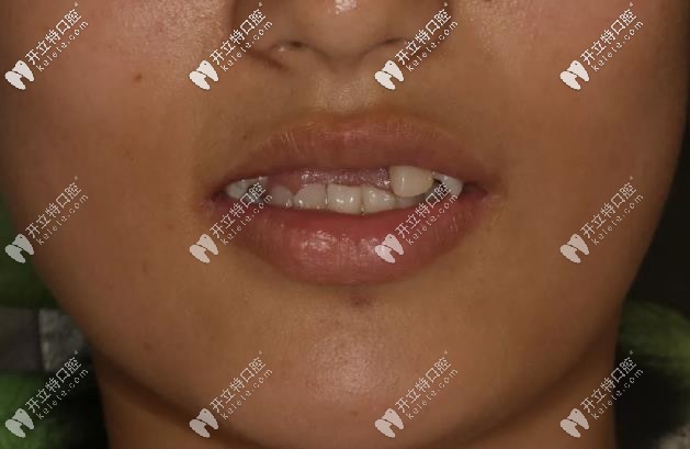 19歲<!--<i data=20240703-sp></i>-->生-摔斷4顆門牙、缺牙四年