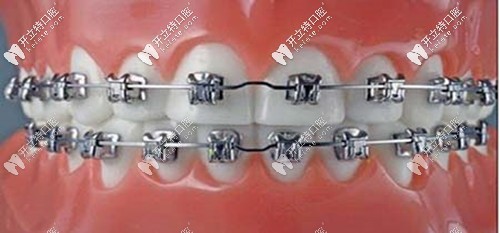 各個品牌自鎖托槽矯正的價格及優(yōu)缺點