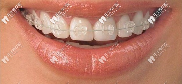 半隱型陶瓷矯正器費(fèi)用