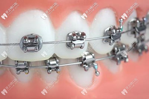 傳統(tǒng)金屬托槽矯正價格