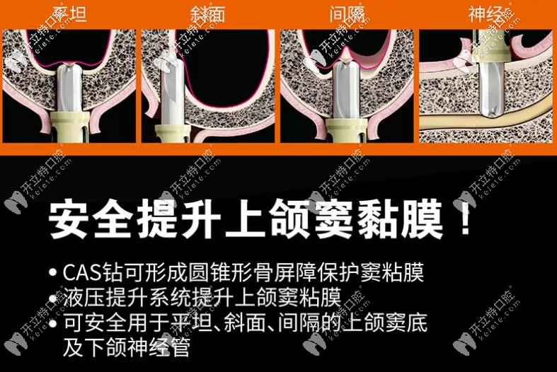 上頜竇提升的安全性