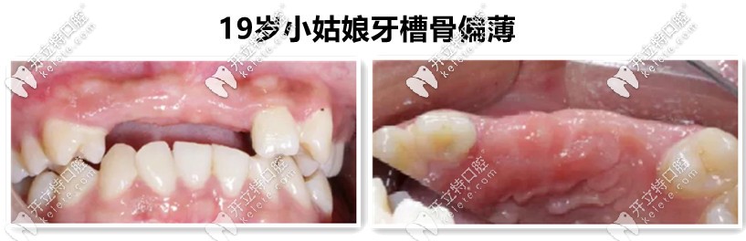 牙槽骨不足，需要植入骨粉