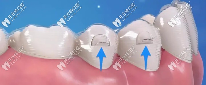 牙齒矯正器上的附件：“小凸點”竟是隱形牙套里的扛把子