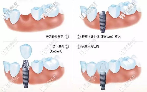 種植牙前需要注意哪些呢？