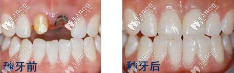 種牙前后對(duì)比