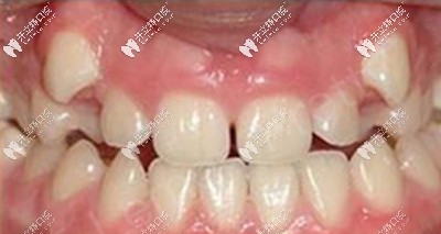 說(shuō)我是齙牙妹一點(diǎn)都不為過(guò)吧