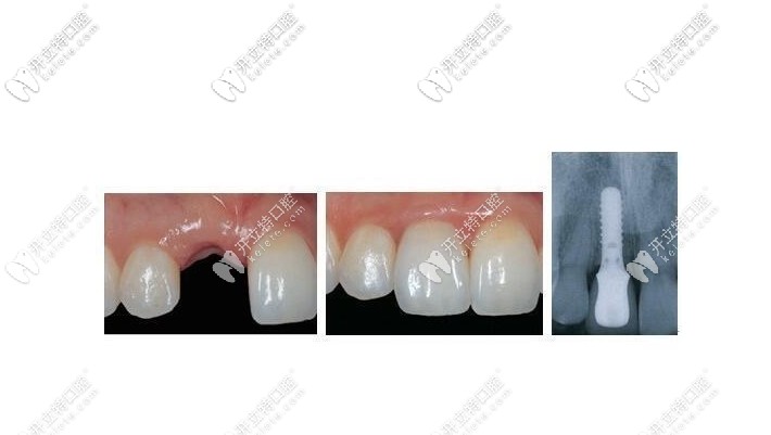 種植牙修復(fù)效果圖