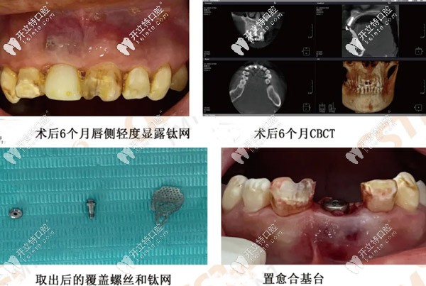 術(shù)后6個(gè)月的效果圖