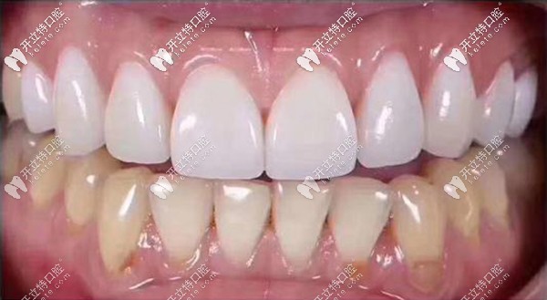 全瓷貼面和樹(shù)脂貼面的區(qū)別~拆過(guò)2次貼面全瓷貼面抗污性強(qiáng)