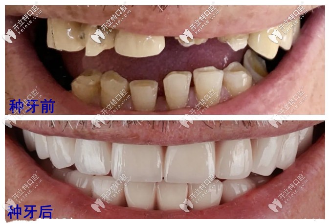 種牙前后對(duì)比