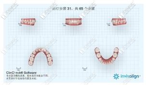 不管戴什么隱形牙套是不是都要重啟?隱形矯正重啟另收費(fèi)嗎