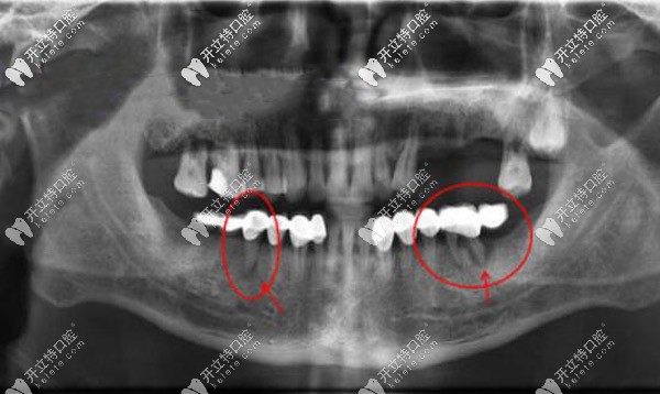 單端固定橋的缺點和禁忌癥你知道嗎?別做了牙才后悔