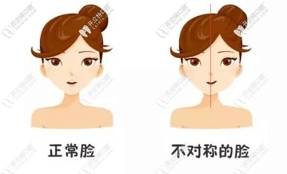 單側(cè)咀嚼的危害不僅導(dǎo)致下頜骨不對稱,且歪臉不一定能恢復(fù)