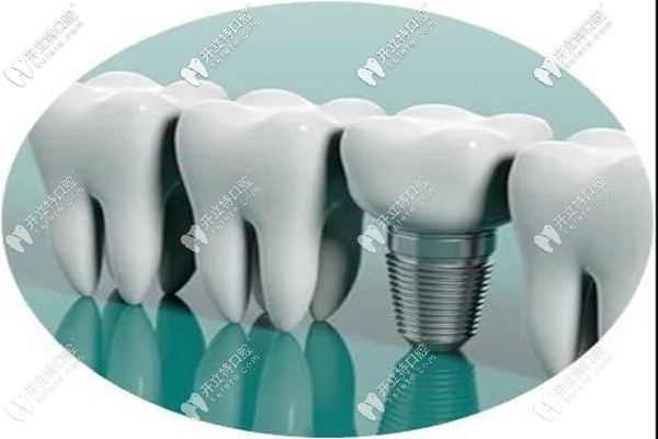 諾貝爾pmc種植體的優(yōu)勢(shì)所在