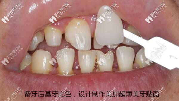 備牙后基牙比色，設(shè)計制作美加超薄美牙貼面