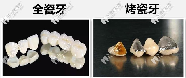 全瓷牙和烤瓷牙區(qū)別