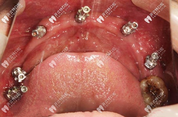 下頜植入6顆種植體的口內(nèi)圖