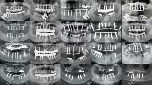 各類全口種植牙的全景片展示圖