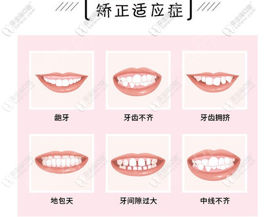 哪些牙齒要做牙齒矯正呢？請對號入座！