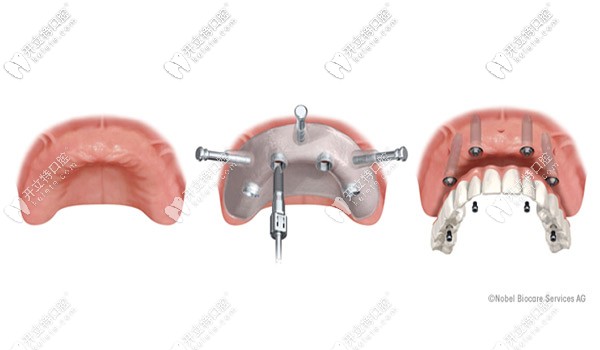 ALL-ON-4種植技術(shù) ALL-ON-4種植技術(shù)