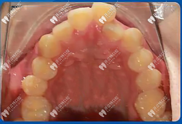 牙齒重度擁擠不齊，牙弓狹窄