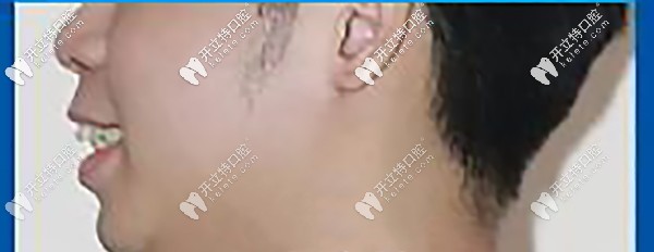 側(cè)面顯凸嘴，唇型厚重，唇肌緊張