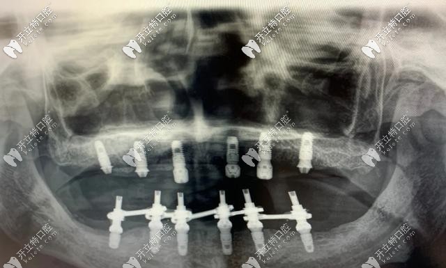 全慶波醫(yī)生分析即刻負(fù)重的種植牙靠譜