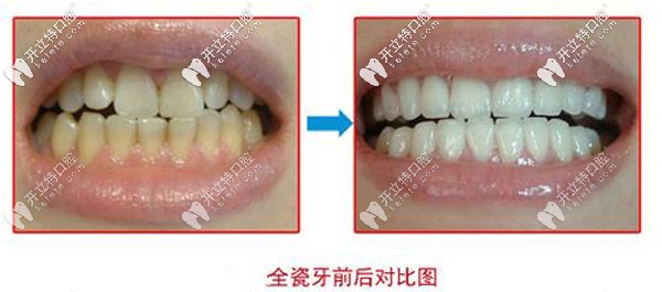 全瓷牙前后對比