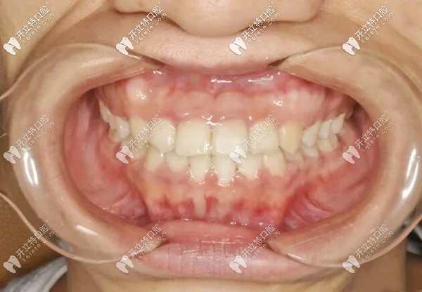 地包天牙齒矯正后的照片