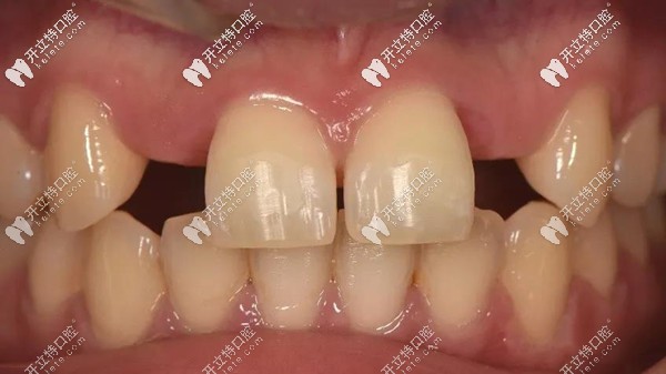 前牙區(qū)用瑞士士卓曼Variobase AS基臺(tái)做即刻種植牙修復(fù)的案例