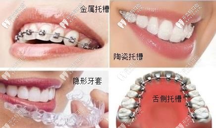 ebrace舌側(cè)矯正牙套大概多少費用?效果相較于唇側(cè)哪個好