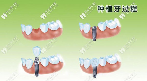 牙齒可以當(dāng)天拔牙當(dāng)天種植嗎
