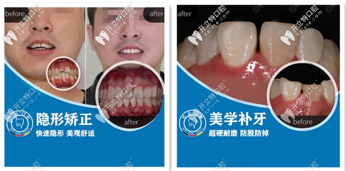 德益口腔-牙齒矯正和補(bǔ)牙案例展示