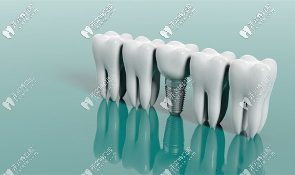 種植4顆植體和6顆植體的費(fèi)用一樣嗎