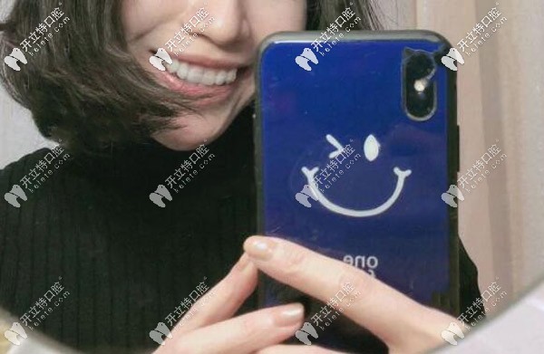 矯正期間牙套臉