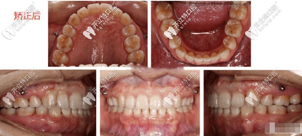 牙齒排齊