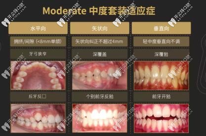 隱適美m(xù)oderate的適應(yīng)癥