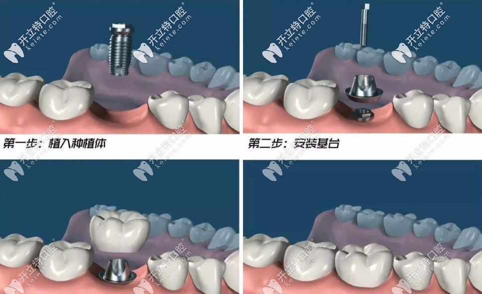 帶上種植牙冠多久能適應(yīng)