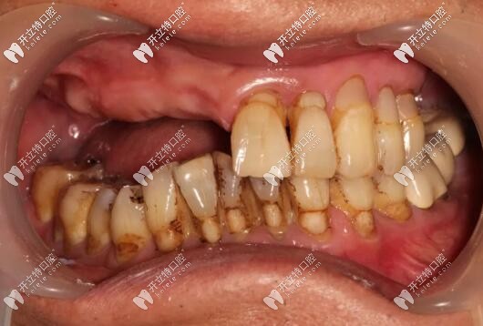 半口種植牙前