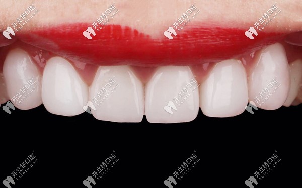 價格相差不多的國產(chǎn)和進口全瓷牙效果圖