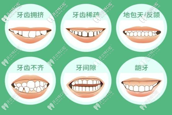 蘭州牙王國口腔金屬矯正，舌側(cè)矯正多少錢