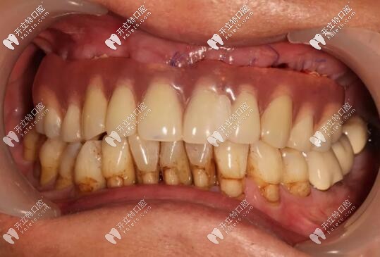 西安美奧口腔即刻種植牙案例