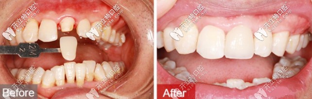 德國(guó)進(jìn)口全瓷牙套價(jià)格表get，威蘭德和國(guó)產(chǎn)愛爾創(chuàng)哪個(gè)好