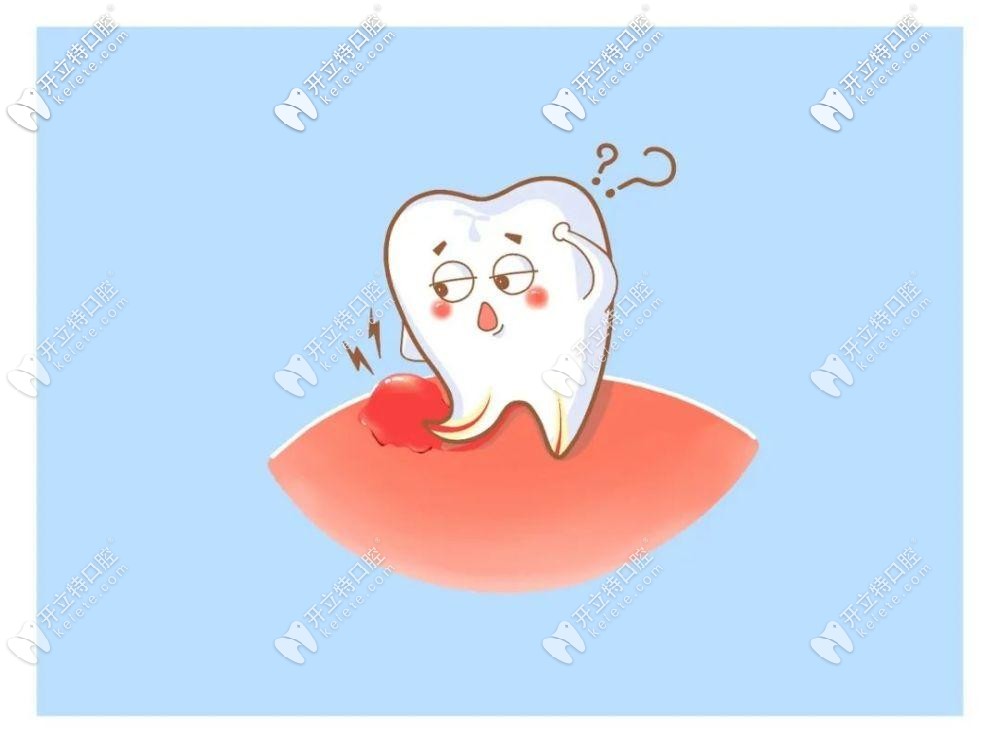 烤瓷牙上面根尖囊腫怎么辦?話說根管治療能消除囊腫嗎