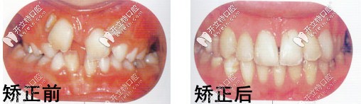南昌輝煌口腔矯正案例