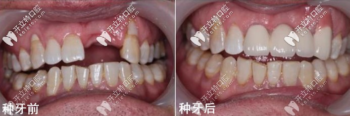 種植牙前后對比