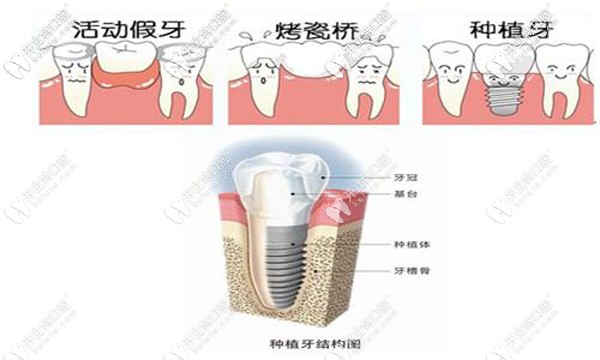種植牙與活動假牙、烤瓷牙對比圖