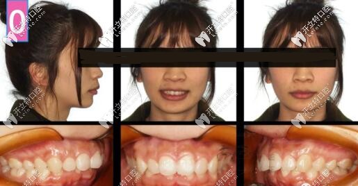 骨性二類凸嘴正畸內(nèi)收3-4mm側(cè)貌效果,金屬自鎖(拔牙+骨釘)